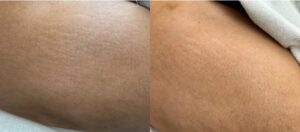 Dry_needling-Pembroke-Pines