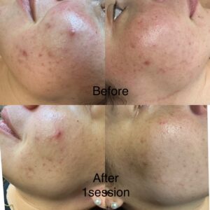 acne-treatment-pembroke-pines