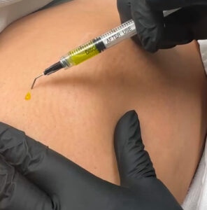 dry-neeling-stretchmarks