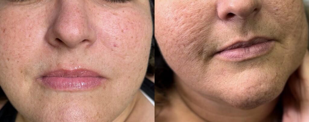 MCA-Needling-pembroke -pines