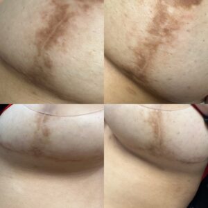 Intimate area lightening with MCA Dry Needling