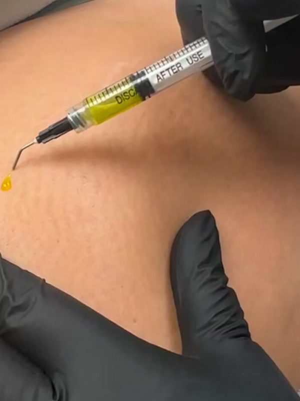 dry-neeling-stretchmarks
